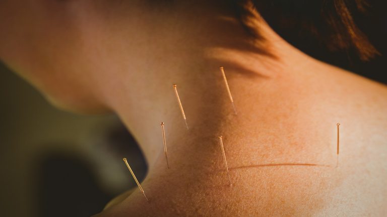 Akupunktio - mitä kaikkea sillä voi hoitaa? Ilmainen luento Kainulassa!